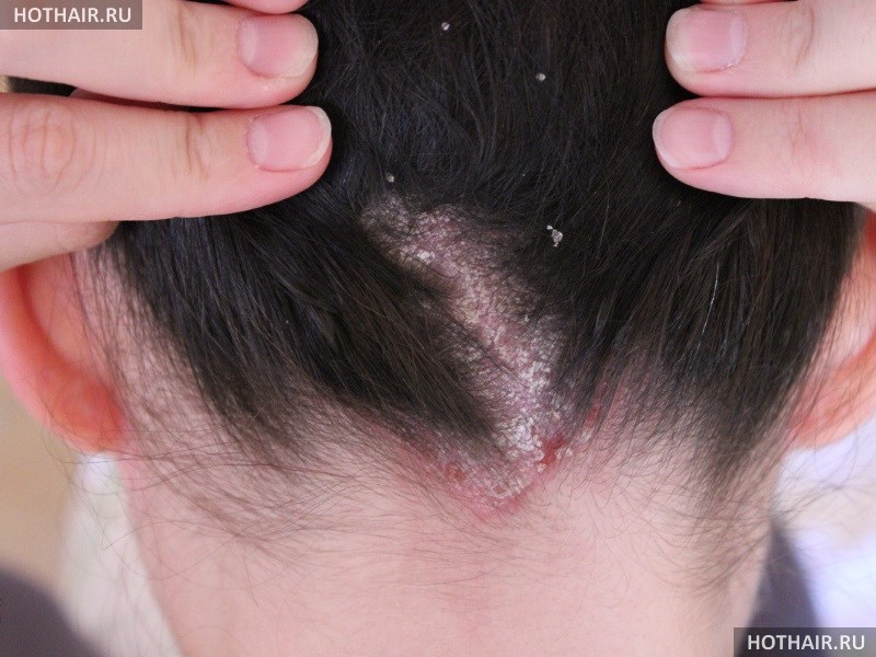 Лечение себорейного дерматита на волосистой части головы 