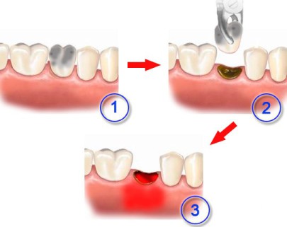 Альвеолит после удаления зуба 29950 1 