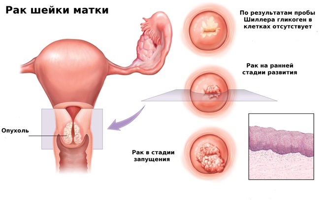 Эффективность прививки против рака шейки матки 