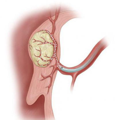 Эмболизация маточных артерий при миоме матки и обильных кровотечениях 