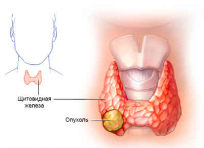 Какие бывают онкомаркеры щитовидной железы? 