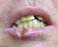 Как выглядит paк губы: симптомы и первые признаки 