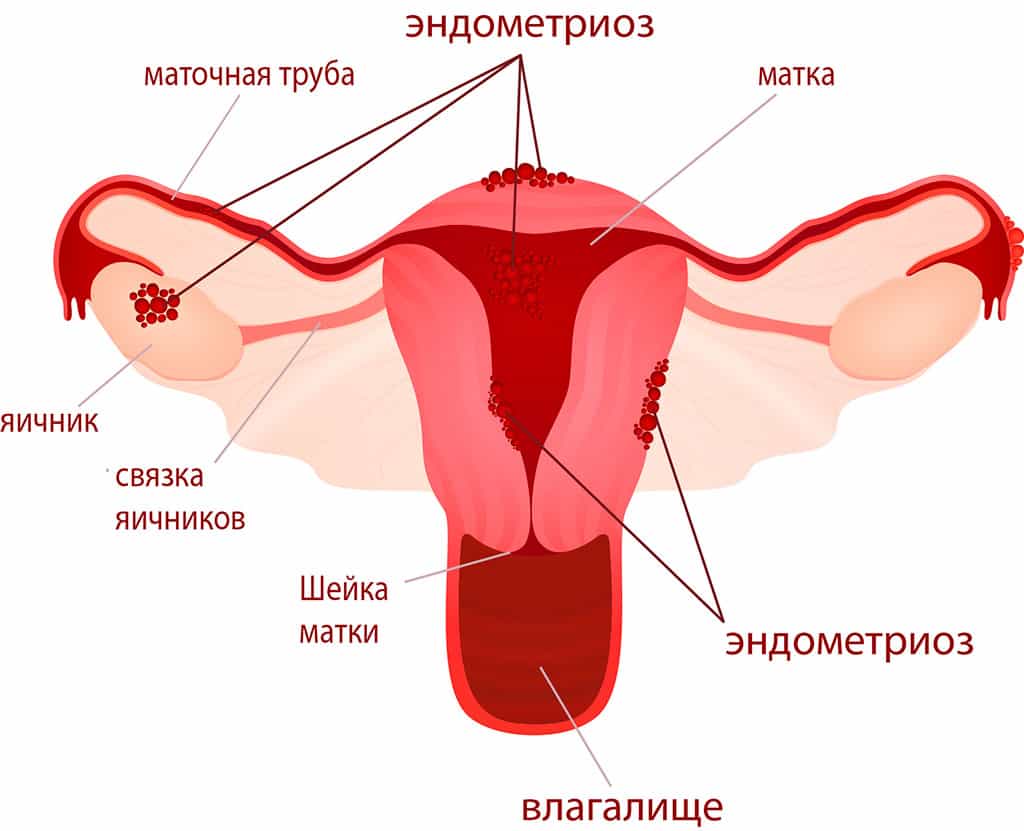 Эндометриоз матки — что это такое, причины, признаки, симптомы и лечение эндометриоза у женщин 