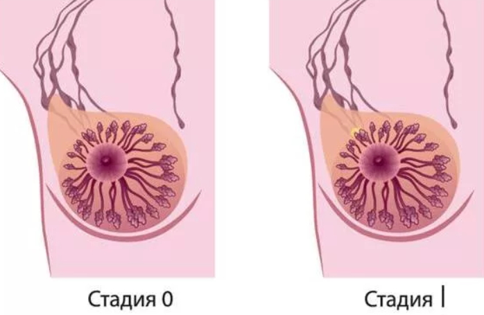 Лечение paка молочной железы 1 стадии 