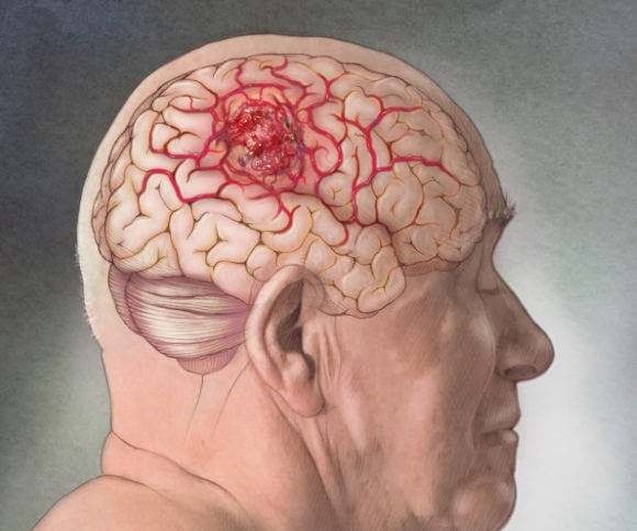 Неоперабельный paк мозга: симптомы, современное лечение 