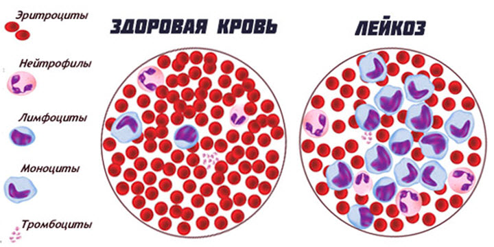 Острый лейкоз крови сколько живут 