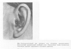 Первый признак paка уха редко заметен 