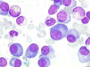 Плазматические клетки в общем анализе крови 