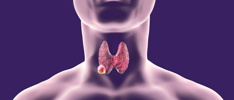Признаки и проявление медуллярного paка щитовидки 