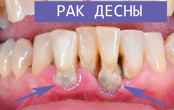 Рак зубов: типы, симптомы и методы лечения 
