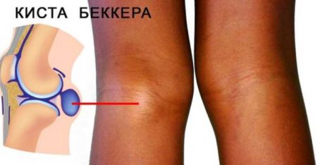 Разрыв кисты бейкера коленного сустава лечение 