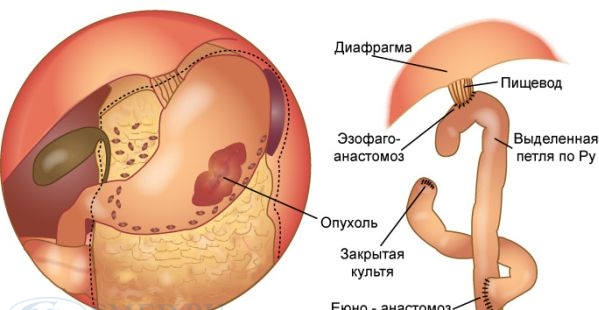 Симптоматика GIST опухоли в желудке и причины ее развития 