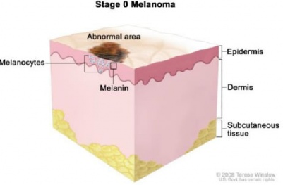 Третья стадия меланомы 