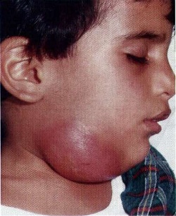 Туберкулез лимфоузлов шеи 