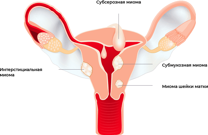 Возможные причины, симптомы и лечение интрамурально-субсерозной миомы матки 