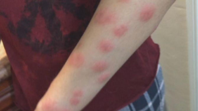 Аллергия на укусы клопов: как проявляется и чем лечить 