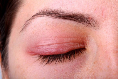 Демодекс: лечение кожи лица и век глаз 