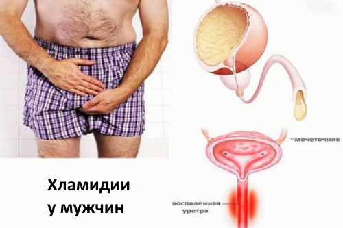 Фотографии симптомов xлaмидиоза у мужчин — без цензуры 
