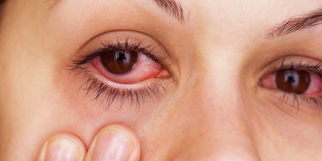 Хламидийная инфекция глаз, признаки и лечение 
