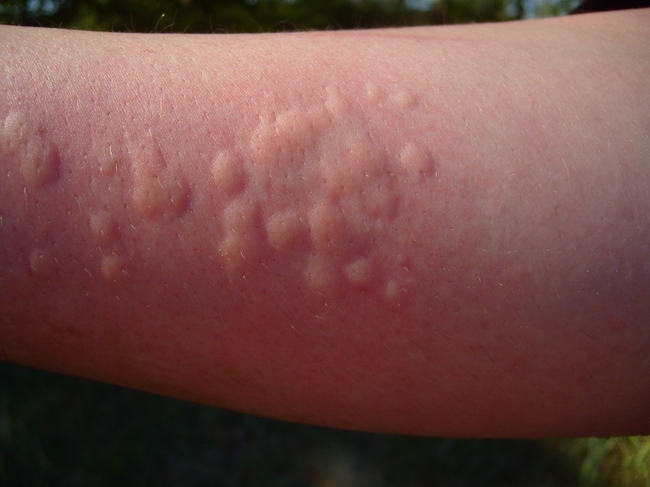 Кулицидоз: аллергия на укус комаров. Симптомы и лечение 