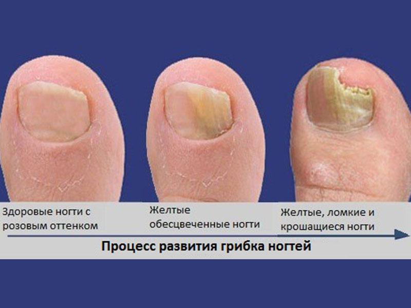 Недорогие, но эффективные препараты для лечения грибка ногтей 