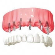Имплантация зубов: суть метода, виды, показания, противопоказания, возможные осложнения 