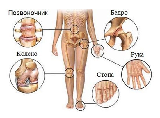 Симптомы и лечение xлaмидийного артрита суставов 