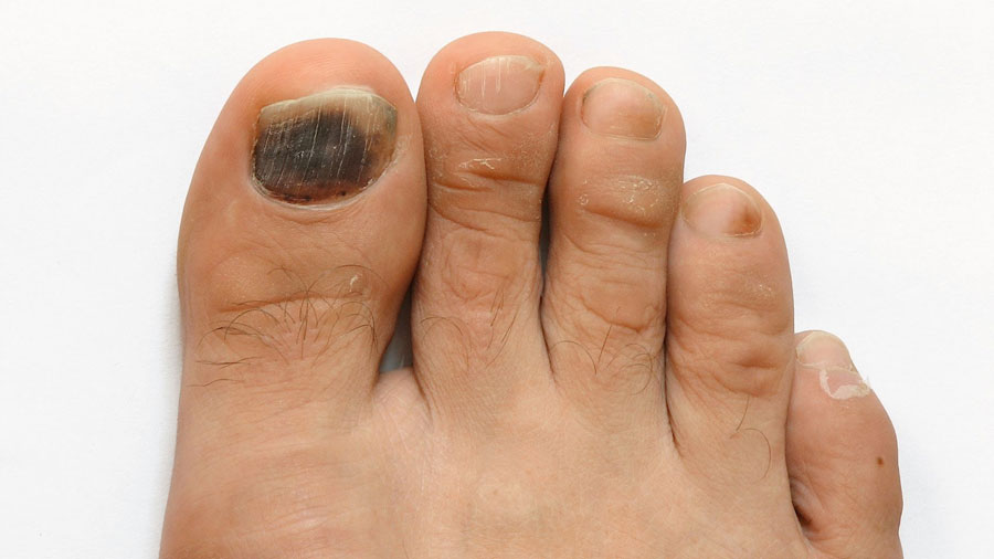 Удаление ногтя на ноге при грибке 