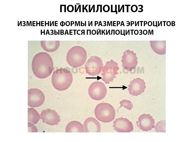 Определение причин пойкилоцитоза в общем анализе крови 