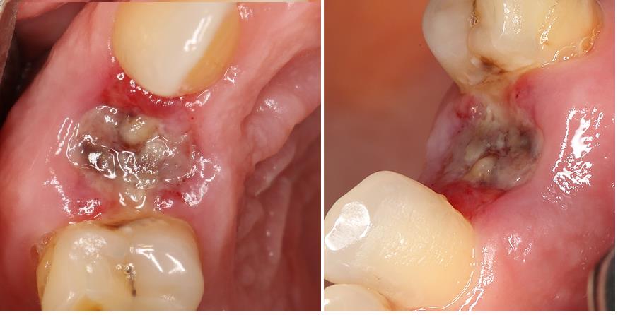 Альвеолит как осложнение после удаления зуба (когда лунка загноилась) 