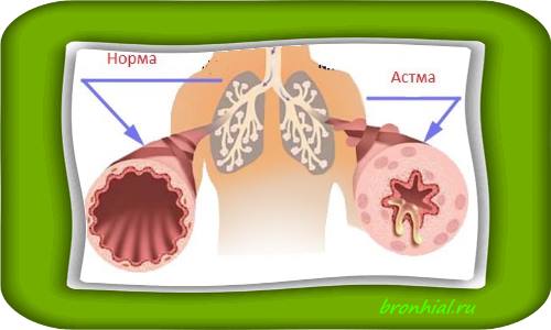 Бронхиальная астма — как начинается и первые признаки у взрослых 