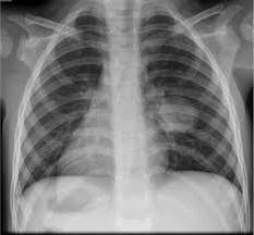 Что показывает рентген грудной клетки, когда может быть назначена процедypa и как она проводится? 