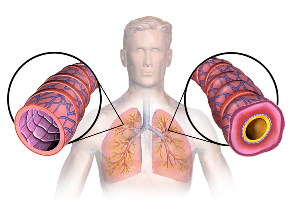 Что приводит к смешанной форме астмы: приступы и меры профилактики 