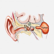 Что такое невринома слухового нерва и как лечить? 