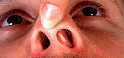 Долго не проходят болячки в носу: чем лечить и что делать? 
