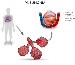 Физиотерапевтическое лечение при пневмонии 