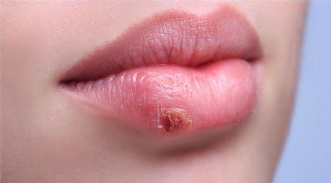 Герпетические высыпания на губах: природа недуга, симптомы, лечение 