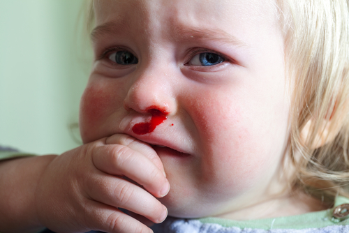 Кровь из носа у ребенка: 10 причин 