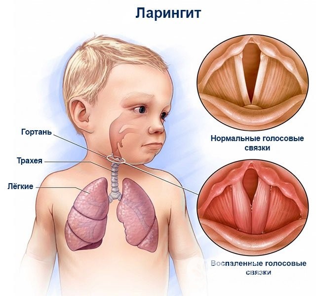 Ларингит у детей первого года жизни: особенности заболевания и лечение 