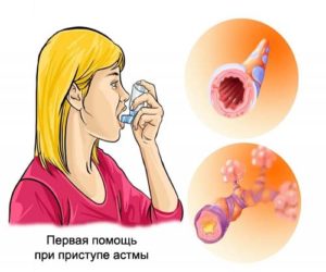 Приступ астмы: симптомы, что делать? Как снять приступ больному без лекарств? 