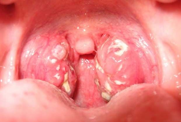 Признаки ангины у маленького ребенка: симптомы с фото горла, лечение и профилактика заболевания 