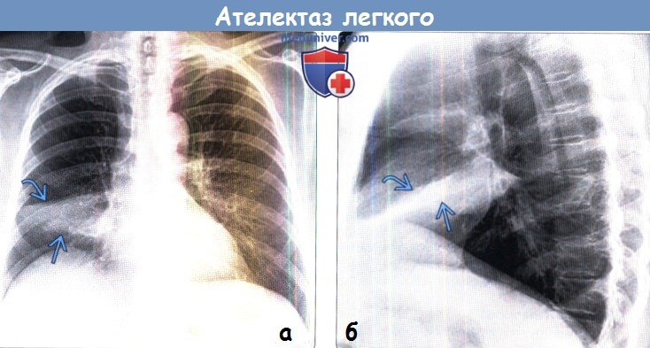 Симптомы и дифференциальная диагностика ателектазов на рентгенограмме 