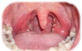 Симптомы и причины гepпeса в горле у взрослых и детей. Как лечить? 