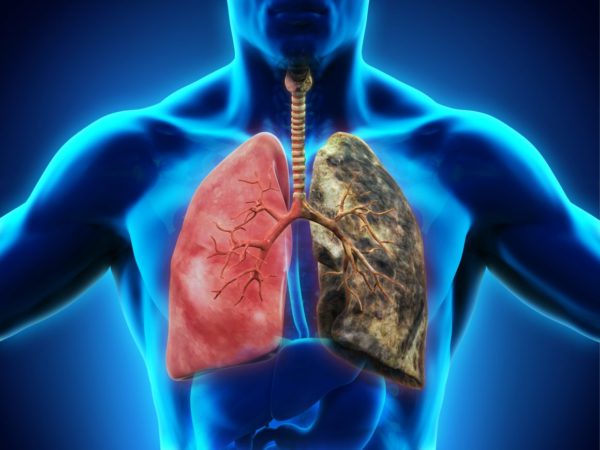 Симптомы плоскоклеточного рака лёгкого: лечение и прогноз выживаемости 