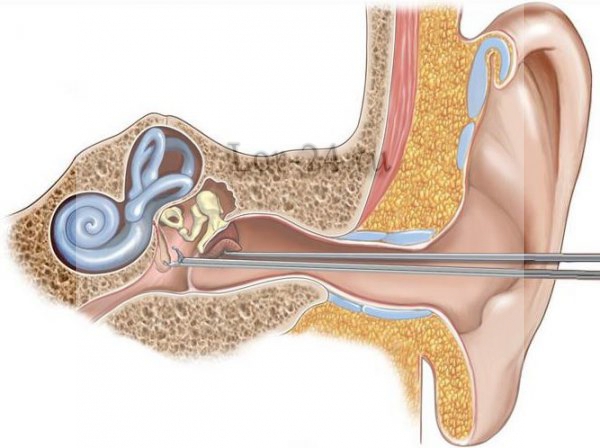 Тимпанопластика уха: когда и как ее проводят 