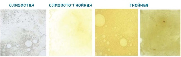 Цвет и хаpaктеристики мокроты при хроническом и остром бронхите 