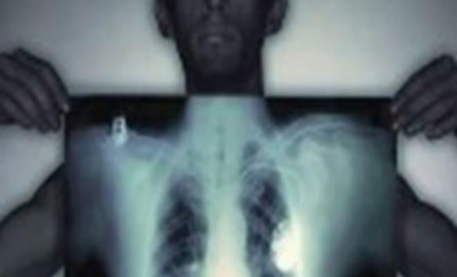 Туберкулёз: причины cмepти 