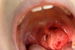 Воспаление гланд и миндалин в горле у взрослых и детей: симптомы, причины, лечение, фото 