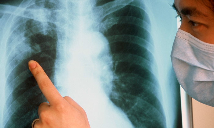 Вторичный туберкулез: причины возвращения и стадии заболевания 