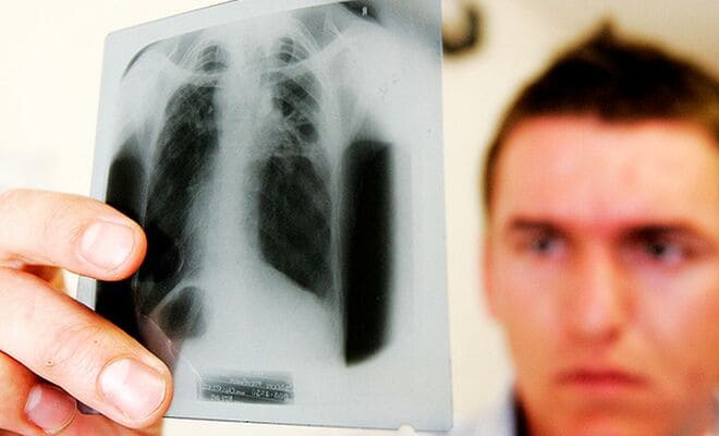 Заразен ли туберкулез: пути передачи и как происходит заражение 